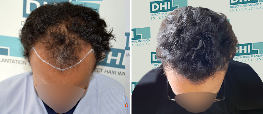 DHI before & after hair transplant results